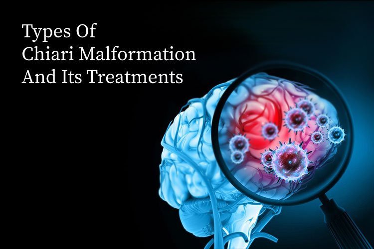 Types of Chiari Malformation and Its Treatments