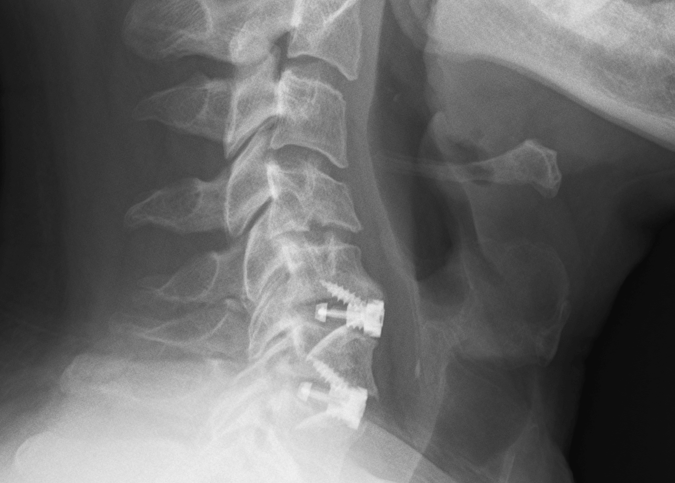 A Guide To Anterior Cervical Discectomy And Fusion Or Acdf